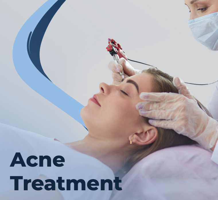 Acne Treatment